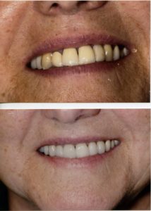 Smile Makeover in Surrey