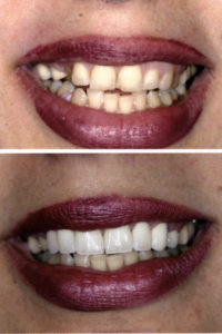 Smile Makeover in Surrey 5