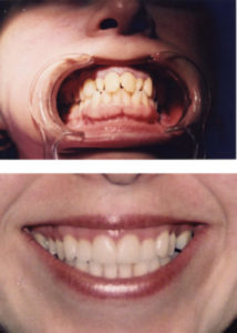 Surrey Smile Makeover 2