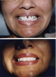 Surrey Smile Makeover