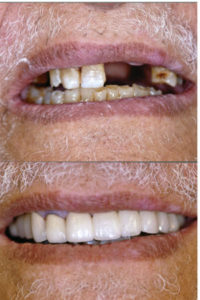 Surrey Smile Makeover 4