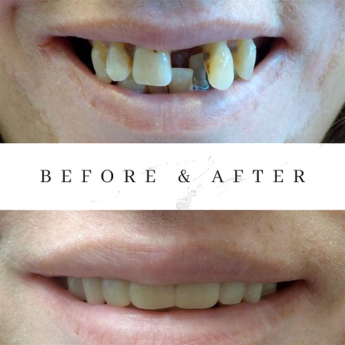 before-after-01 before and after implants