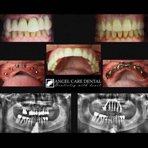 before and after implants