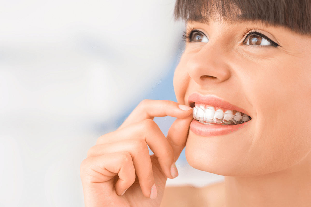 Surrey what you need to know before starting invisalign