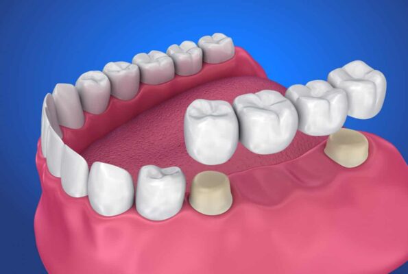 Delta hi so you’ve received a dental bridge now what Delta hi so you’ve received a dental bridge now what