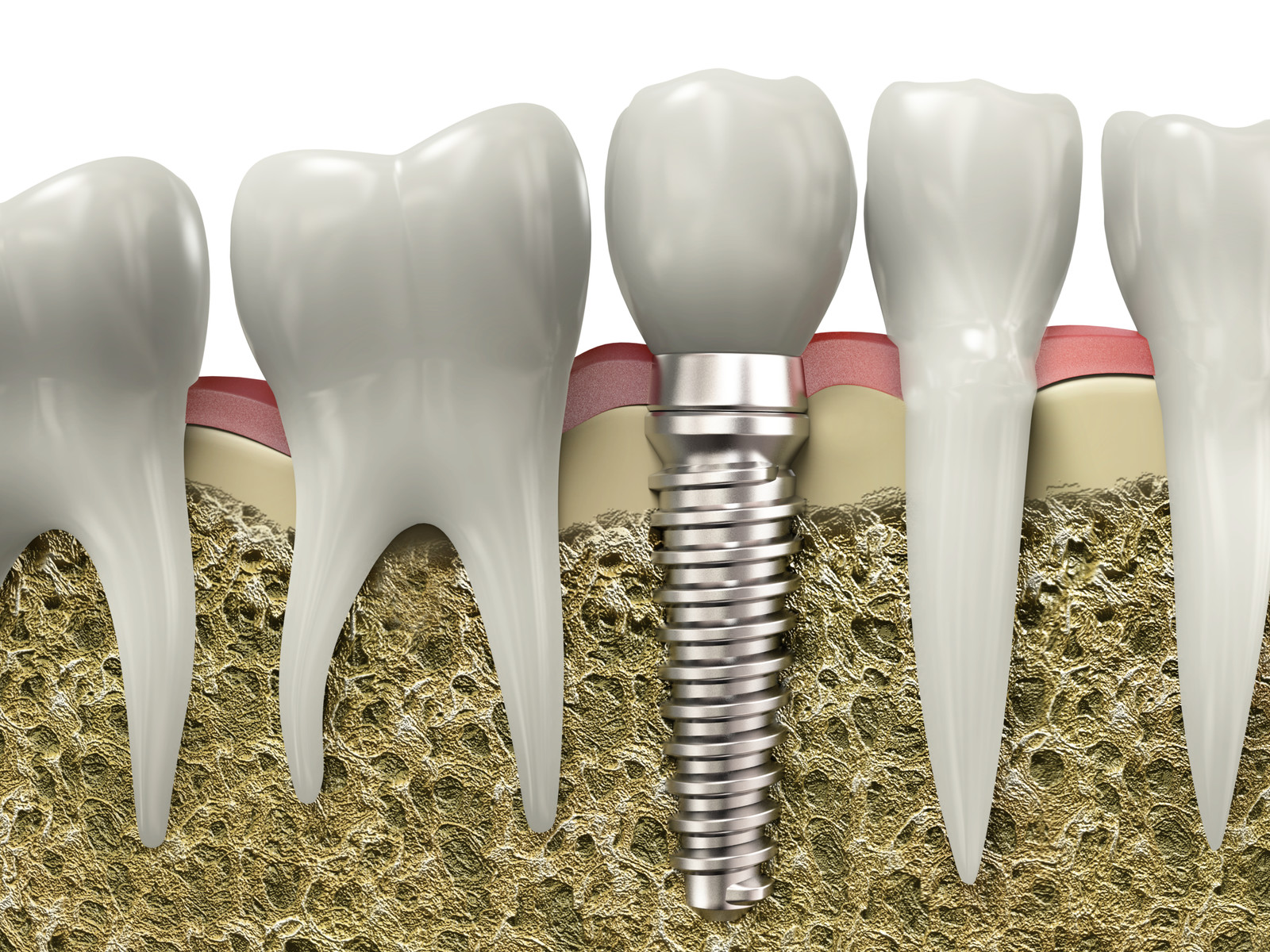 are-you-a-good-candidate-for-dental-implants