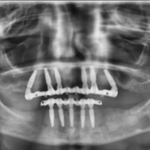 Delta Overdenture Dental 10