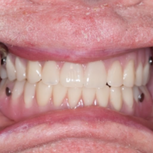 Delta Overdenture Dental 11