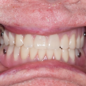 Delta Overdenture Dental 11 Delta Overdenture Dental 11