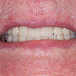 Delta Overdenture Dental 12