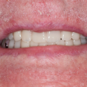 Delta Overdenture Dental 12 Delta Overdenture Dental 12