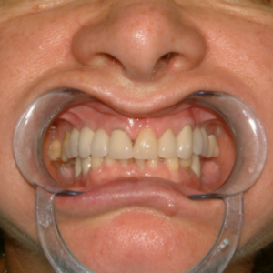 Delta Overdenture Dental 2