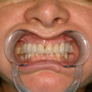 Delta Overdenture Dental 2 Delta Overdenture Dental 2