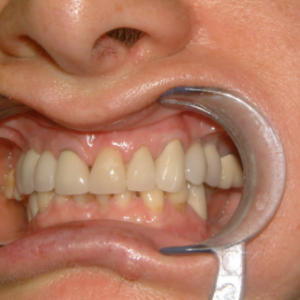 Delta Overdenture Dental 3