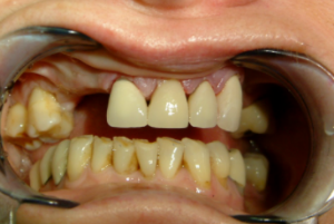 Delta Overdenture Dental