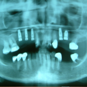 Delta Overdenture Dental 4