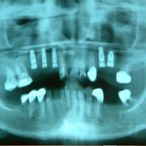 Delta Overdenture Dental 4 Delta Overdenture Dental 4