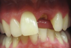 Delta Overdenture Dental 5