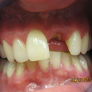 Delta Overdenture Dental 5