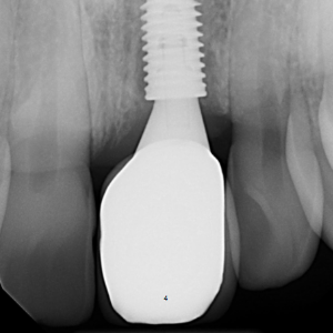 Delta Overdenture Dental 6