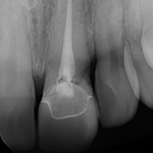 Delta Overdenture Dental 7