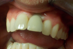 Delta Overdenture Dental 8