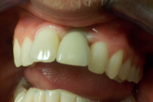 Delta Overdenture Dental 8 Delta Overdenture Dental 8
