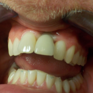 Delta Overdenture Dental 8
