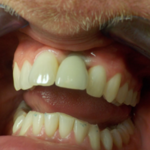 Delta Overdenture Dental 8 Delta Overdenture Dental 8