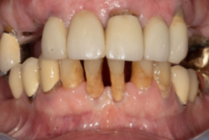 Delta Overdenture Dental 9