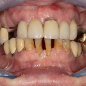 Delta Overdenture Dental 9