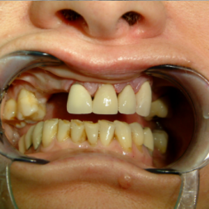 Delta Overdenture Dental