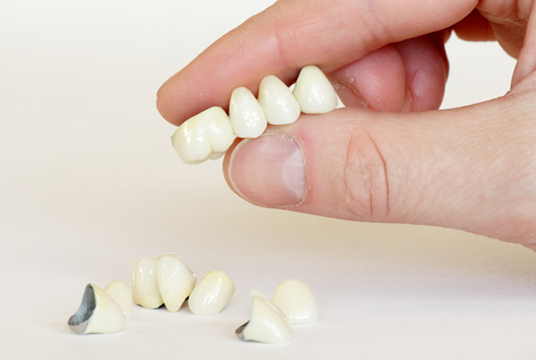 Surrey dental crowns near you Surrey dental crowns near you