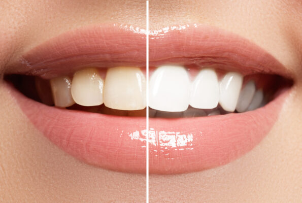 Perfect,Smile,Before,And,After,Bleaching.,Dental,Care,And,Whitening