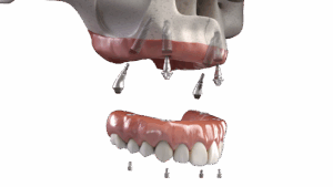 All-on-x - full arch implant solutions 